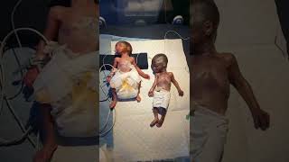 Twins  Twin Pregnancy  Babies in the womb  Multiple Pregnancy shortsfeed twins baby fyp [upl. by Labana]