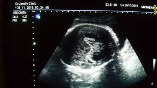 Hydrocephalus Ultrasound [upl. by Sathrum523]