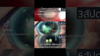 neurotrophic keratitis [upl. by Clareta]