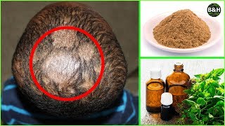 Ringworm Hair Loss Treatment  How To Get Rid of Scalp Fungus Instantly Tinea Capitis [upl. by Annij]