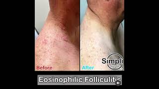 Eosinophilic Folliculitis [upl. by Zillah]