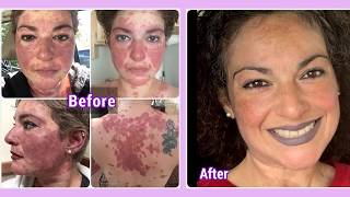 Lupus Rash Treatment Amazing Before and After Skin Rash Relief [upl. by Nessim]