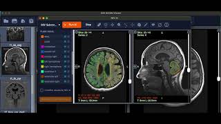 Automated Brain Measurements with AI  IMV Subcortical [upl. by Norb547]