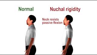 Nuchal rigidity  pathognomonic sign of meningeal irritation [upl. by Sabine]