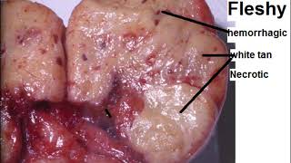 Fibrosarcoma skill lab [upl. by Kcirdnekel]