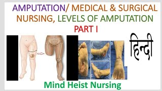 Amputation 《Medicat ampSurgical PART I》 Explained In Hindi [upl. by Albrecht]