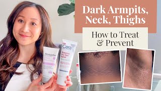 Treating and Preventing Dark Armpits Thighs Neck and Arms  Dr Jenny Liu [upl. by Ettenot]