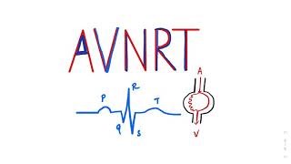 Atrioventricular Nodal Reentrant Tachycardia AVNRT SVT ecgtutorial cardiology AVRT Arrhythmia [upl. by Esir]