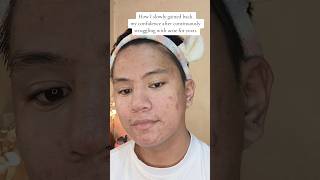 Just trust the process 😍😍 acnejourney skincare acne [upl. by Erodeht]