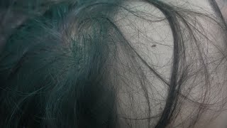 Lice Popping and Nitpicking  Lice Remove From My Hair [upl. by Purdum]