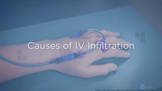 Causes of IV Infiltration  Training Video [upl. by Areic480]