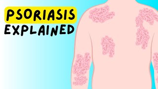 What is Psoriasis Definition Etiology Classification Pathophysiology Diagnosis Treatment [upl. by Leahey]