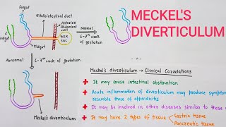 Meckels Diverticulum With Clinical Correlations [upl. by Eek]