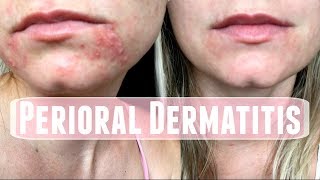 Perioral Dermatitis How I treated it [upl. by Ashatan970]