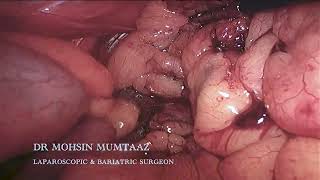 Sleeve Gastrectomy  Performed By Dr Mohsin Mumtaaz  Bariatric Surgery [upl. by Annaig]