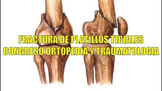 Mal unión fracturas platillos tibiales 👉🏻 Ortopedia y traumatología [upl. by Iaht]