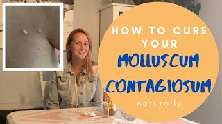 Molluscum Contagiosum How to cure it Naturally with Apple Cider Vinegar [upl. by Anidualc]