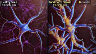 Wake up dormant dopaminergic neurons to reverse Parkinson’s disease [upl. by Hpejsoj907]