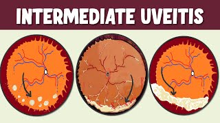 Intermediate Uveitis Spotlight on Symptoms Signs and Potential Complications [upl. by Assyl]