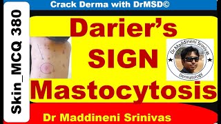 DARIERS SIGN  Mastocytosis  Urticaria Pigmentosa  Wheal  Histamine  Dermographism  DrMSD [upl. by Quinton]