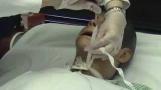 Trach Care Part 2mov [upl. by Anahs920]