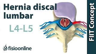 Hernia discal lumbar entre la L4 y L5 o cuarta y quinta vértebras lumbares [upl. by Ogu261]