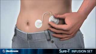 How to insert the Medtronic MiniMed SureT infusion set  diabetes therapy [upl. by Eirlav]