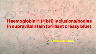 HbH Inclusions Hb H bodiesthalassaemia trait [upl. by Yblocaj433]