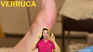 Quick amp Effective Verruca Removal Advanced Treatments Explained  Miss Foot Fixer [upl. by Viva250]