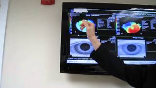 AN EXPLANATION OF CORNEAL TOPOGRAPHY AND KERATOCONUS [upl. by Sitoel]