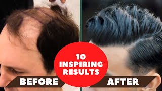 10 Inspiring Hair Transplant Results Before amp After [upl. by Yecats842]