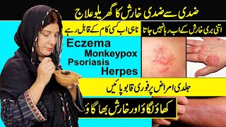 How to Treat Skin Allergies at Home  Eczema  Psoriasis  Monkeypox  Kharish Ka Fori Ilaj [upl. by Honora413]