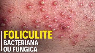 COMO SABER SE A FOLICULITE É BACTERIANA OU FÚNGICA SAIBA AGORA [upl. by Neurath]