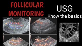 Follicular monitoring USG  The basics [upl. by Lemor]