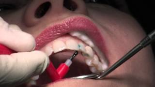 Composite Fillings [upl. by Alicsirp]