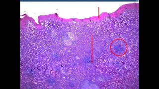 Sarcoidosis Rhino Actinomycosis Leprosy FB 2024  jars and slides [upl. by Athalia]