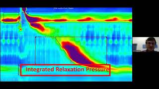 Oesophageal dysmotility cases  simplifying manometry interpretation  Dr M Scriba [upl. by Porche]