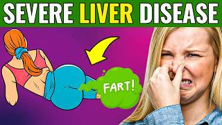 17 SIGNS that your LIVER is DYING  DANGEROUS [upl. by Erbma]