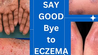 Management guidelines of eczema skin specialist advice How to treat eczemaskinhealthvitality5959 [upl. by Akimrehs710]