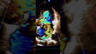 Mitral valve prolapse of the posterior leaflet see description [upl. by Nitza]