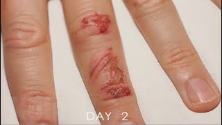 Timelapse Of A Wound Healing [upl. by Narrad]