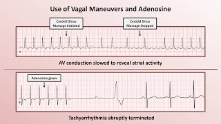 Intro to EKG Interpretation  How to Identify Any Tachyarrhythmia with 6 Easy Questions [upl. by Aiveneg]