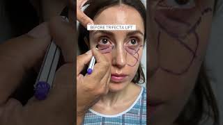 Patient Review Before and After Trifecta Lift with Dr Kami Parsa  6 Weeks Postop [upl. by Vincelette593]