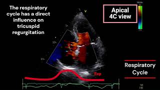 Tricuspid Regurgitation and Respiratory Cycle [upl. by Amalita]