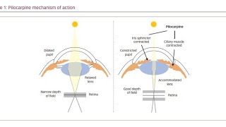 Using Muscarinic Agonist drugs Pilocarpine to treat Glaucoma [upl. by Sargent]