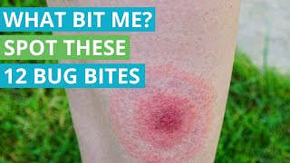 What Bit Me Spot These 12 Bug Bites [upl. by Anyat370]