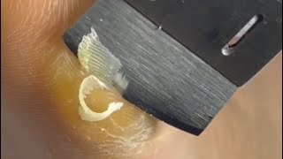 Remove the dead skin from the side of the foot [upl. by Aiket]