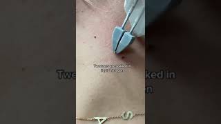 Doctors shows painless way to get rid of skin tags in the clinic  208SkinDoc [upl. by Wickner]