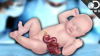 Why Some Babies Are Born With Organs On The Outside [upl. by Nnoj]