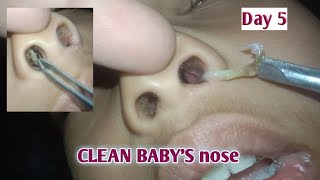 CLEAN BABYS nose day 5 [upl. by Onek606]